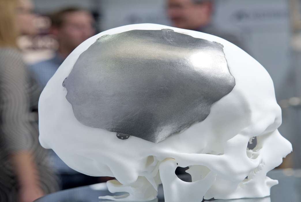 3D-printed bones might help prevent infections. (AP Photo/Jens Meyer)