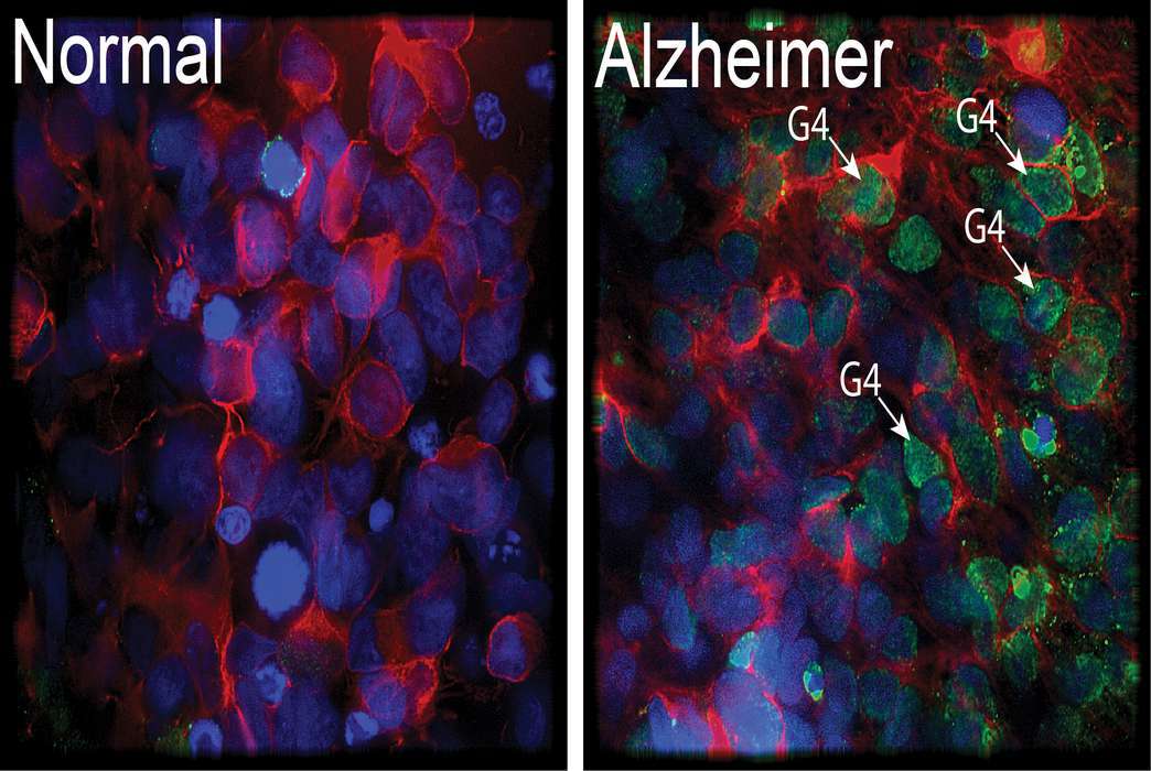 Neurons produced from stem cells are analyzed for G4 structures, which are disruptive configurations of DNA sequences. They are much more prevalent in Alzheimer's disease neurons, according to new research. (University of Montreal/Bernier lab)