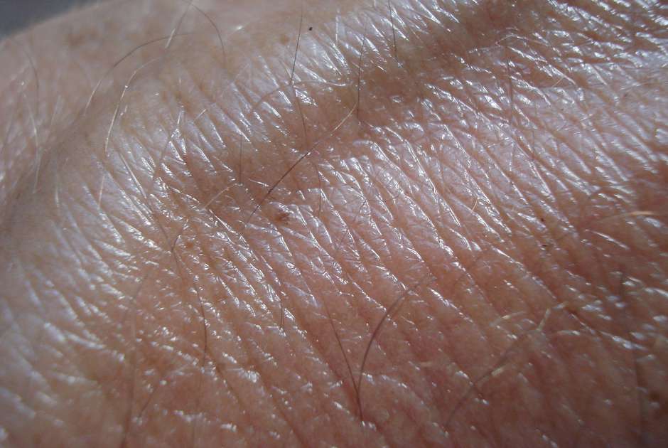 3D-printed skin may soon be an option for diabetic skin issues. (Pixabay/Beeki)